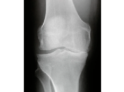 Ceļa locītavas artrozes diagnoze