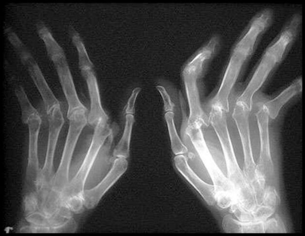 X -Ray attēls ar artrozi skarto roku attēls