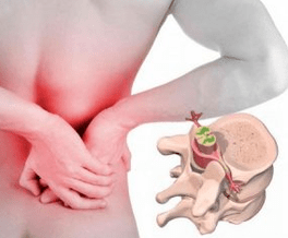 Lumbago slimības sākumā osteohondrozi