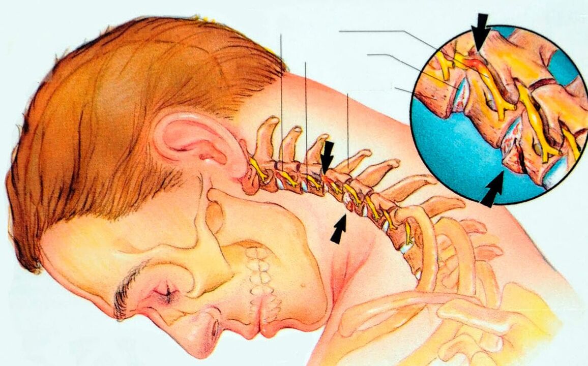 Kas ir dzemdes kakla osteohondroze