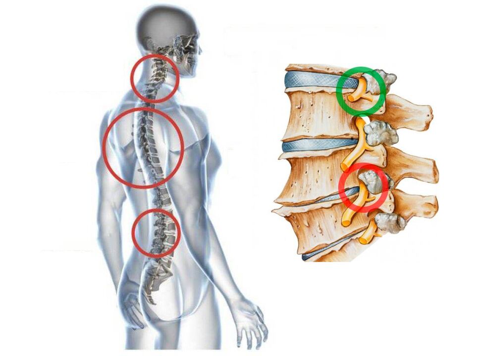 Kā izskatās skriemeļu dzemdes kakla osteohondroze