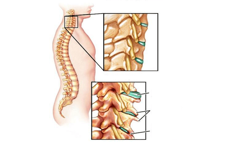 Osteohondrozes sindromi