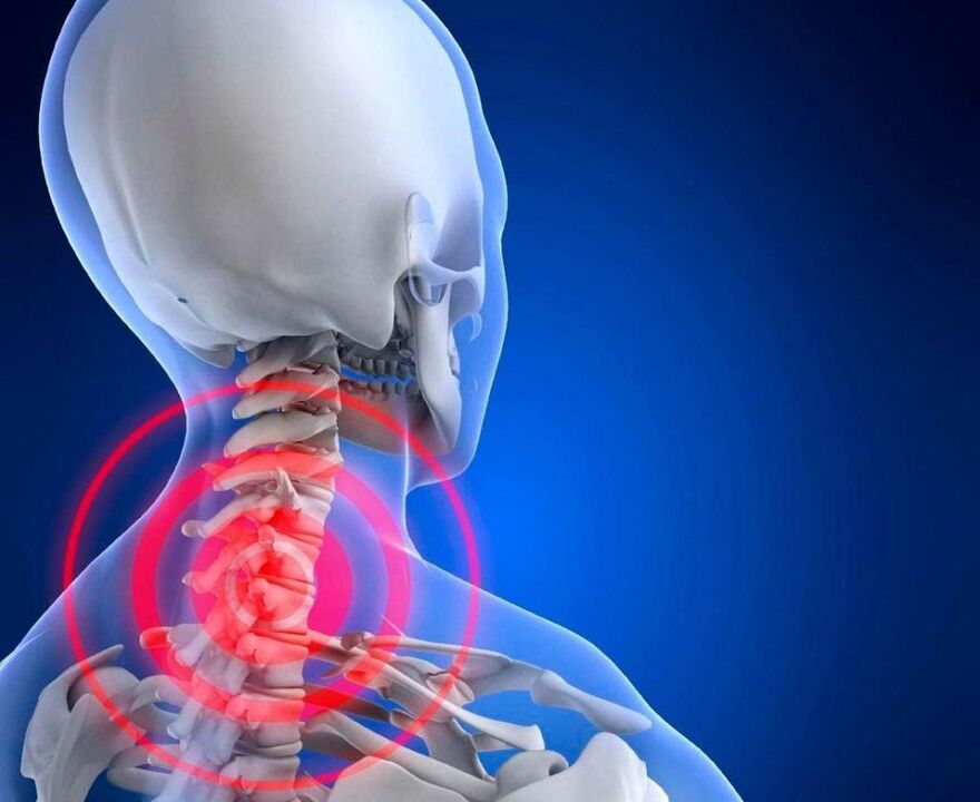 kakla sāpes ar dzemdes kakla osteohondrozi