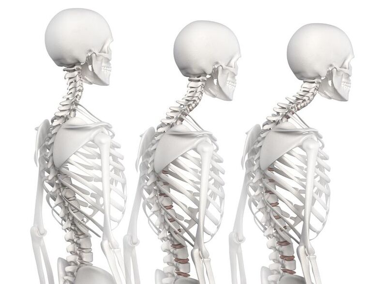 Krūškurvja osteohondrozes attīstības pakāpes, izmantojot skeleta modeļa piemēru