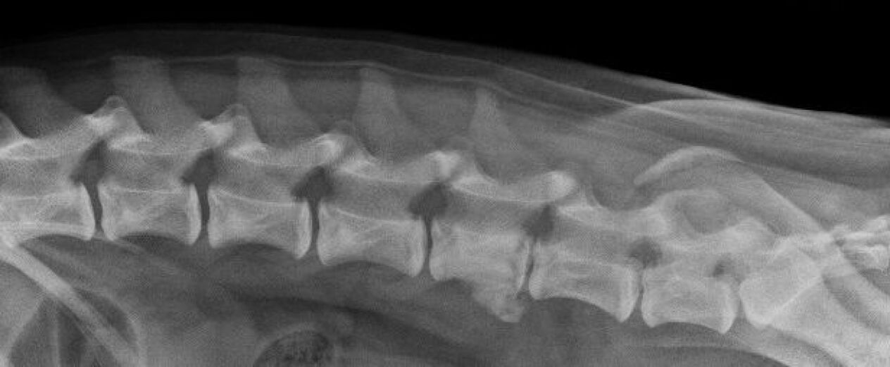Mugurkaula krūšu kurvja osteohondrozes izpausmes rentgenā